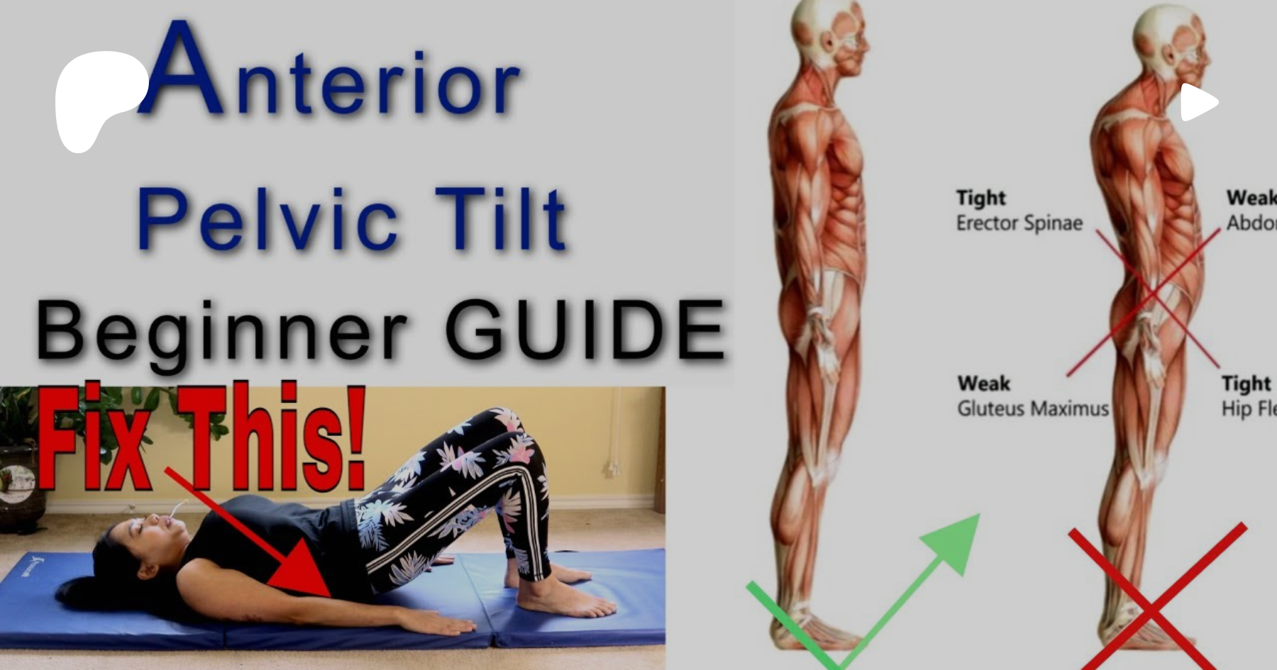 How To Fix Anterior Pelvic Tilt Posture - 10 Exercises