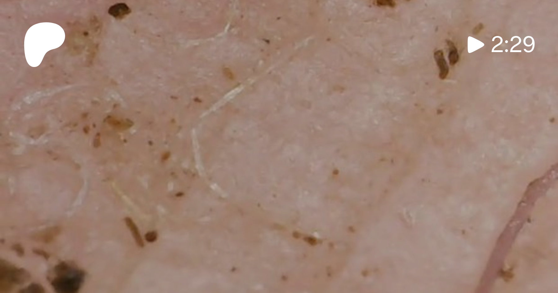 FOOT BOTTOM SHEDDING | BRYAN396 IONIC NANO TECH RESEARCH AND DETOX.